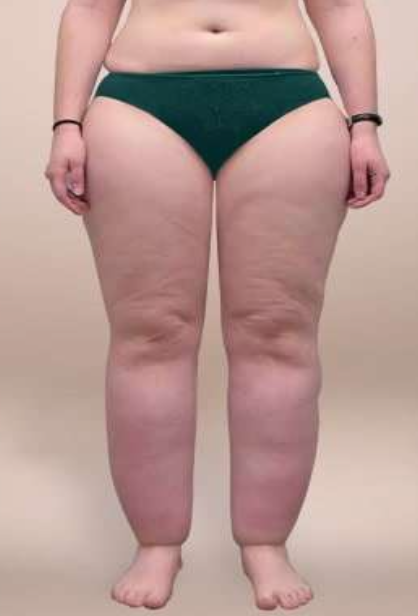 Lipedema degli arti inferiori