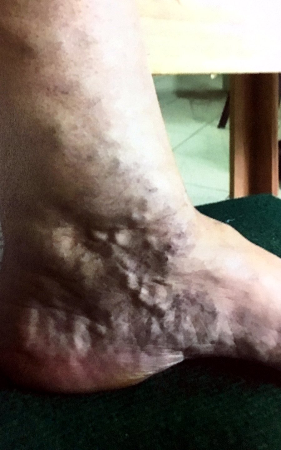 Alterazioni cutanee da stasi venosa alla caviglia